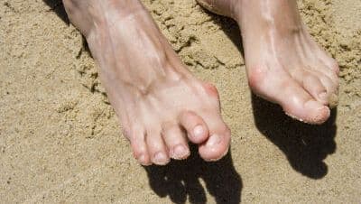Skjev stortå (hallux valgus)