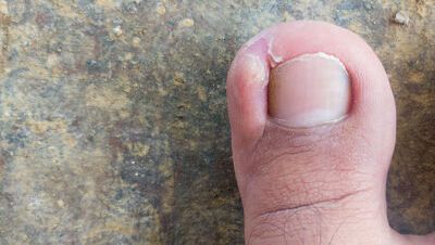 Inngrodd negl/negletrang